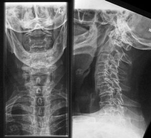X-ray of the cervical spine a method to diagnose osteochondrosis