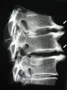 Osteophytes in the cervical spine cause neck pain. 