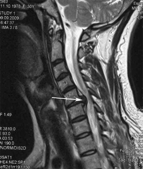 Spinal cord damage triggers neck pain