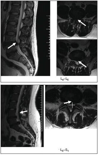 Magnetic resonance imaging of the herniated disc of the spine
