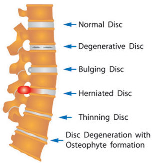 various damages in the disc of the spine